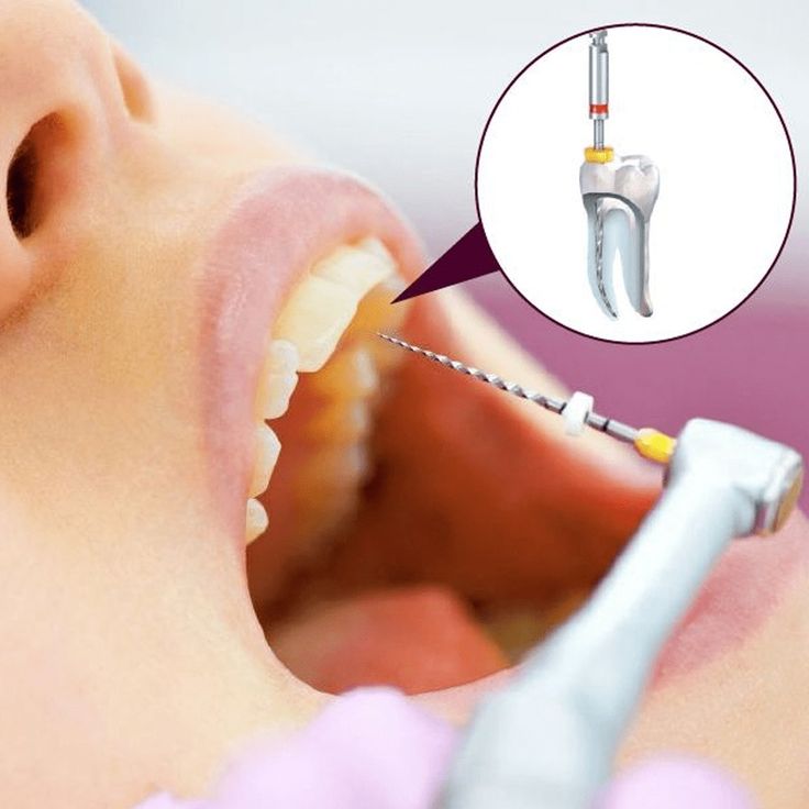 Root canal procedure